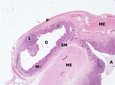 Diverticulosis Histology