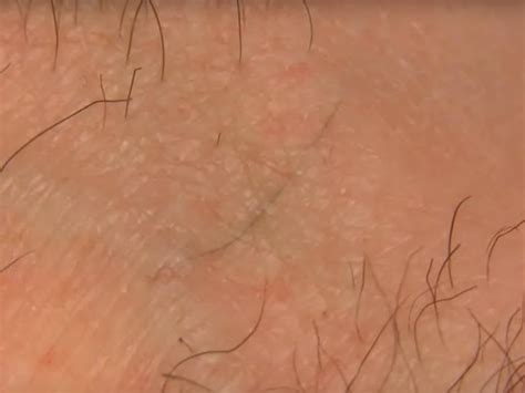 Ingrown Hair Cyst Treatments Causes And Prevention 43 Off