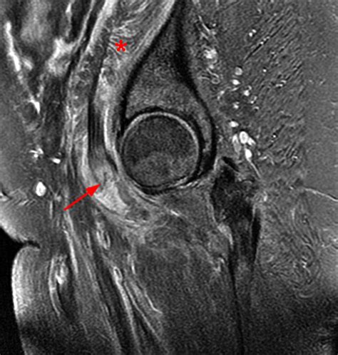 Iliopsoas Tendinopathy | Radsource