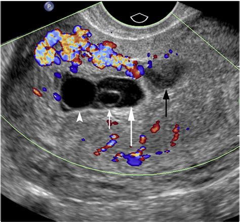 Pearls And Pitfalls In First Trimester Obstetric Sonography Clinical Imaging