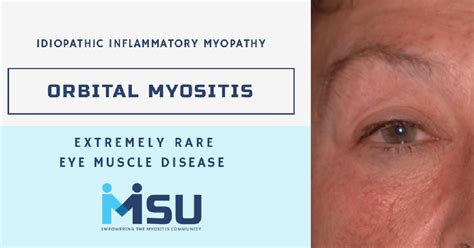 Staying The Course Myositis Support And Understanding Bank2home