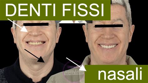 Denti Fissi Nasali Stop Ricostruzioni Ossee Youtube