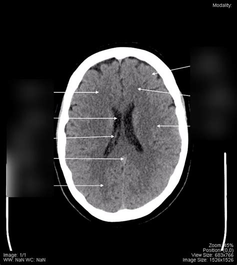 Diagram of CT head anatomy 1 | Quizlet