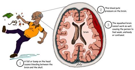 Could A Medication Help With Bleeding Between The Skull And The Brain