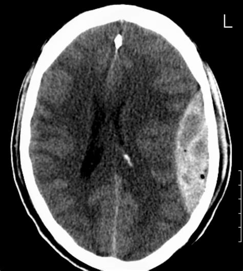 Extradural Hematoma Ncct Sumers Radiology Blog