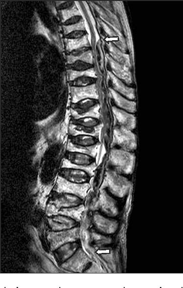 Figure From Spinal Epidural Hematoma After Epidural Anesthesia In A