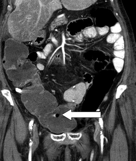 Gas Bubble Motion Artifact In Mdct Ajr