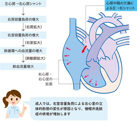 心房中隔欠損症（asd） 看護roo カンゴルー