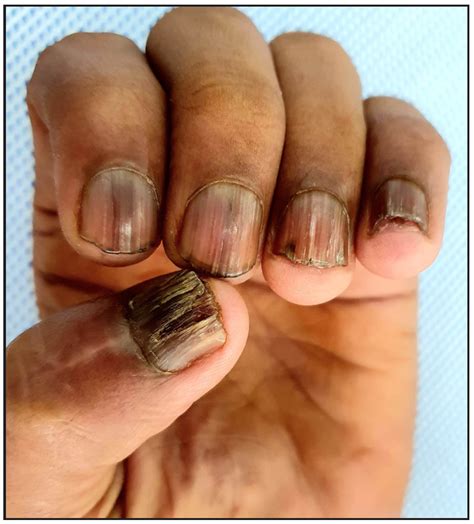 Clinical Characteristics And Management Outcomes In Isolated Nail