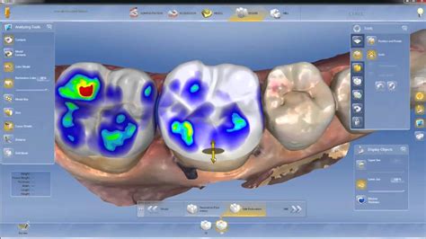 Cerec Sw 44 Tutorial 5 Design Phase Youtube