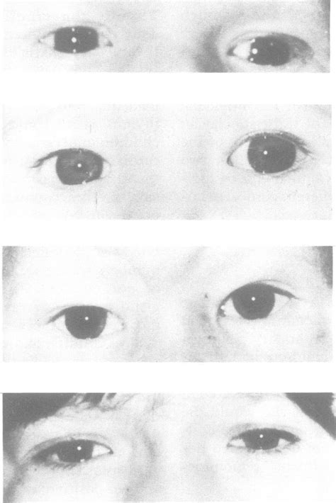 Nasal Root And Eyes In A Baby Top And Infant With Digeorge Syndrome