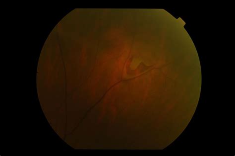 Retinal Tear or Detachment — STRATHFIELD RETINA CLINIC