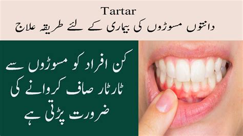 Tartar Teeth Treatment In Urdu Danton Ki Bimari Tartar Ke 6 Tarika Ilaj