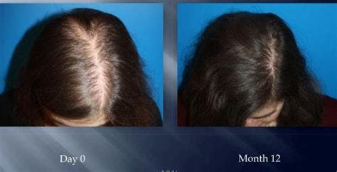 Female Hair Restoration Before & After Photos | Dr. Guy Cappuccino