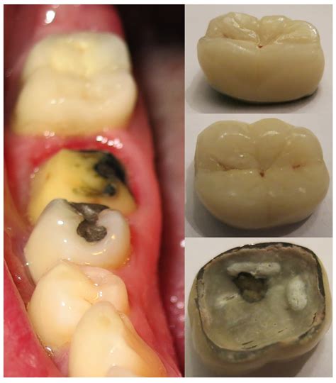 Dental Care: Crowns For Teeth