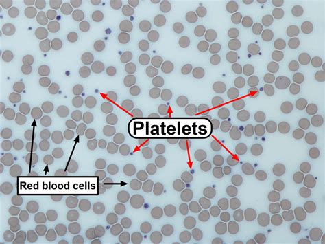 Thrombocytopenia - Causes, Signs, Symptoms, Diagnosis, Treatment