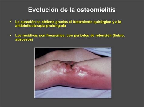 1 Osteomielitis Agudas Upap