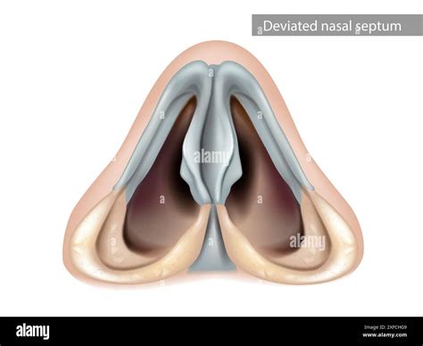 Deviated Nasal Septum Nose Nasal Cavity Inferior View Stock Vector Image And Art Alamy