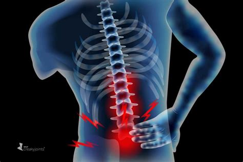 Few Non Radiographic Axial Spondyloarthritis Patients End Up With Spine