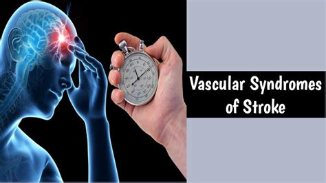 Vascular Syndromes Of Strokestroke Syndromestypes Of Stroke