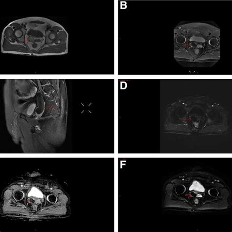 Contrast Enhanced Pelvic Magnetic Resonance Imaging Mri Confirmed A