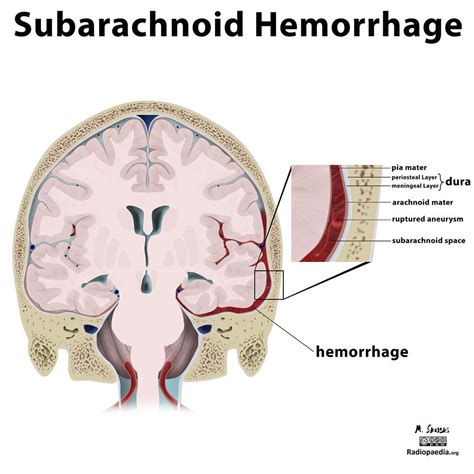 Diagram Intracranial Haemorrhage Radiology Case