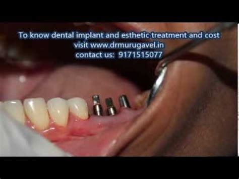 Extraction Of Infected Root Canal Treated Teeth With Immediate Dental