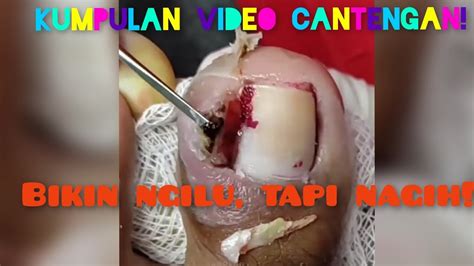 CARA MENGOBATI MENYEMBUHKAN CANTENGAN TANPA CABUT KUKU INGROWN NAIL