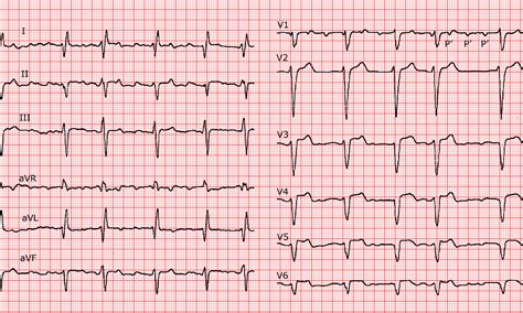 Cardio FR Atrial Tachycardia With Variable Conduction