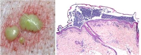 Dermatology Pustules Erosions And Ulcers Flashcards Quizlet