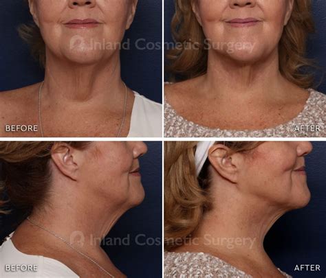 Renuvion Rancho Cucamonga Inland Cosmetic Surgery