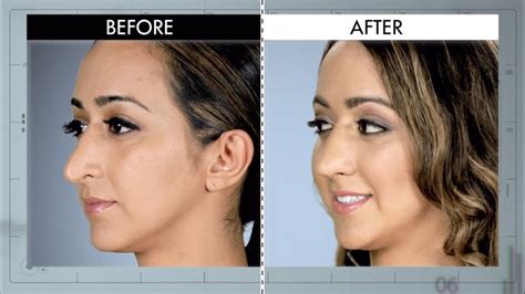 Dentist Nose from Botched Patients Before and After—Shocking ...