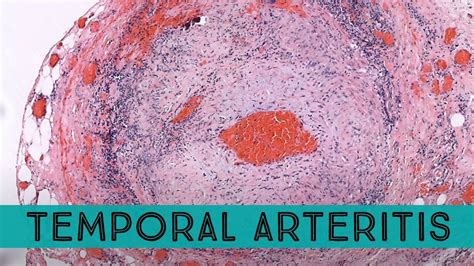 Temporal Arteritis Giant Cell Arteritis Under The Microscope