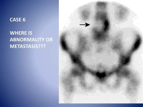 Introduction to Bone Scan: Techniques and Diagnosis | PPT