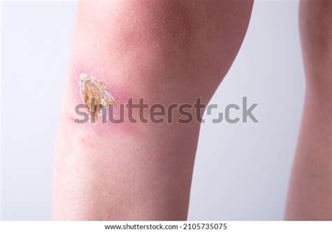 23 Wound Epithelialization Stock Photos, Images & Photography ...