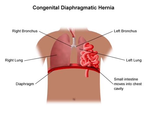 Congenital Diaphragmatic Hernia Treatment In Bangalore