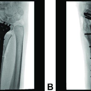 Fluoroscopic Images A Anteroposterior And B Lateral Views Of The