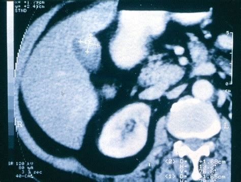 Image Of Polypoid Lesion Of The Fundus Of The Gallbladder On CT Scan