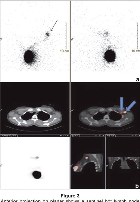 Figure From The Role Of Spect Ct In Detection And Localization Of