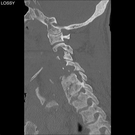 Osteomyelitis X Ray Spine