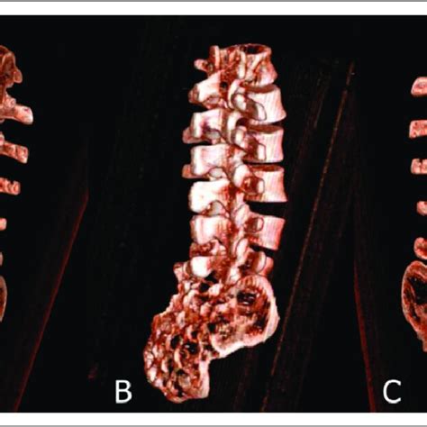 CT Reconstruction Of The Radiopaque Sawbones Lumbar Spine Model A