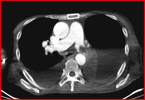 JLE Sang Thrombose Vaisseaux Embolie Pulmonaire Une Cause Rare De