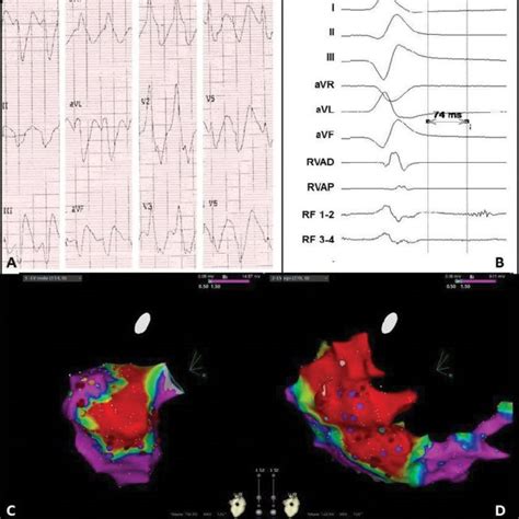 Electrocardiogram And Electro Anatomical Maps Of Case 5 A Twelve Lead