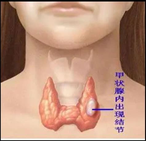 别被甲状腺结节吓到了 知乎