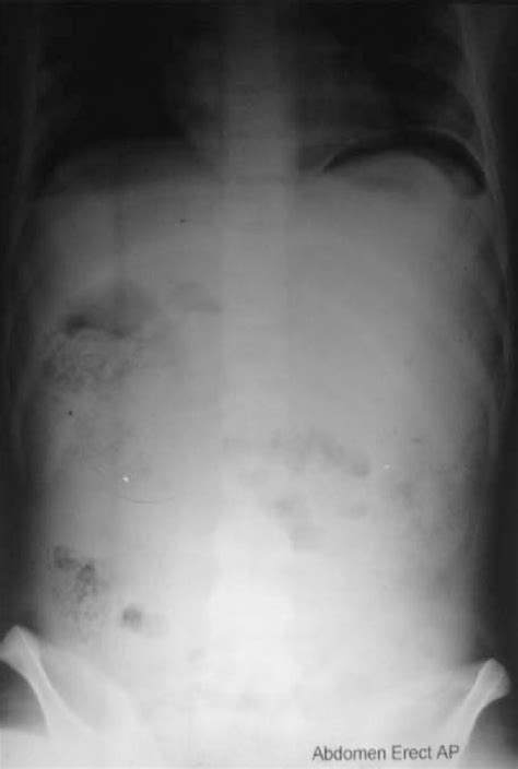 Abdominal X Ray Showing Gas Under The Diaphragm Download Scientific Diagram