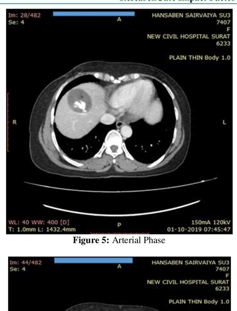 PDF Case Of Mature Cystic Teratoma Of Liver Semantic Scholar