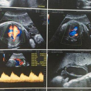 Colour Doppler Imaging Of Turbulent Blood Flow Within The Aneurysm