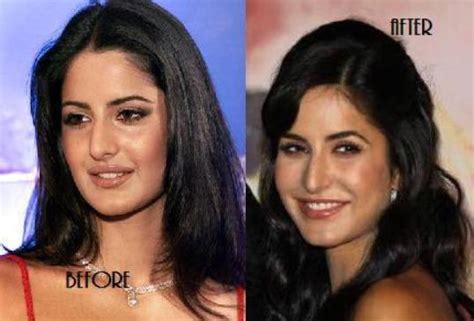 Katrina Kaif Looks After Lip Surgery Chinki Pinki