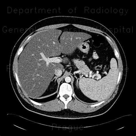 Radiology case: Liver steatosis