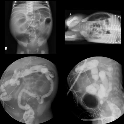 Ileal Atresia Pediatric Radiology Reference Article Pediatric